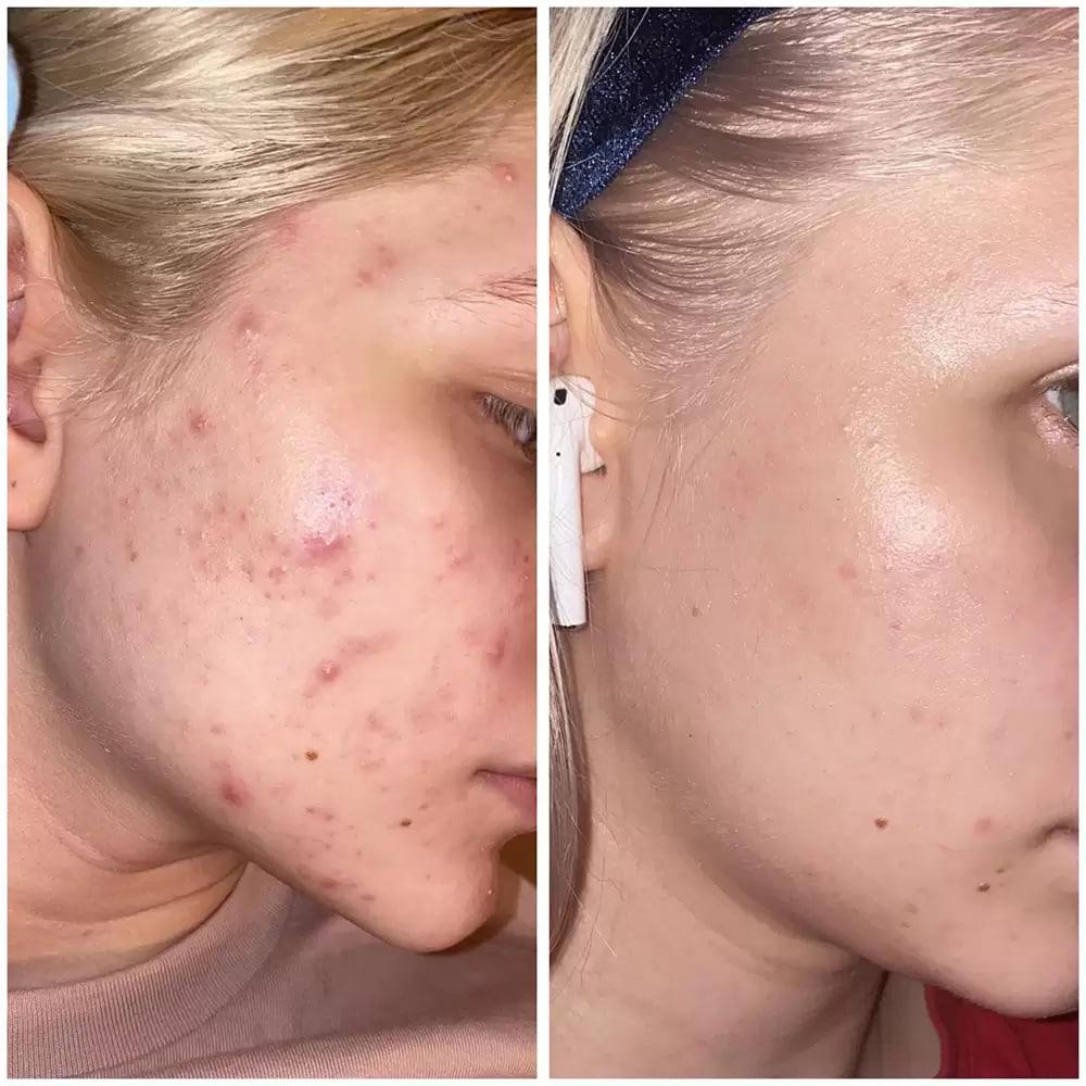 The Ordinary Lactic Acid 5% + Ha 30ml